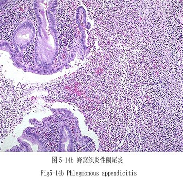 蜂窝织炎性阑尾炎