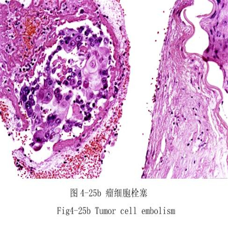 瘤细胞栓塞