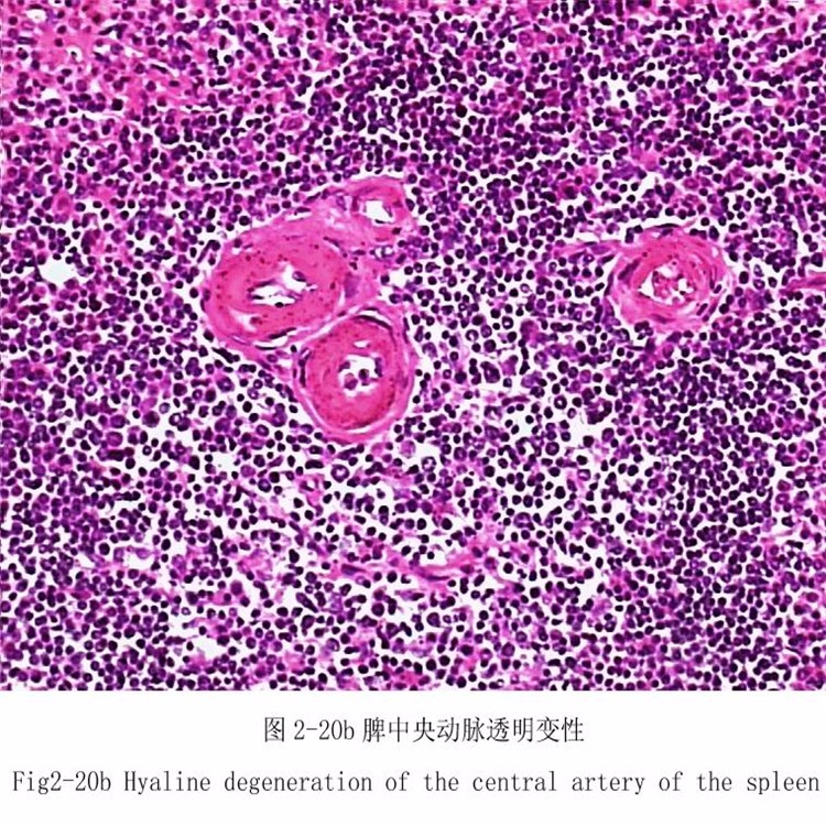 脾中央动脉透明变性