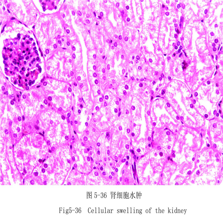 肾细胞水肿