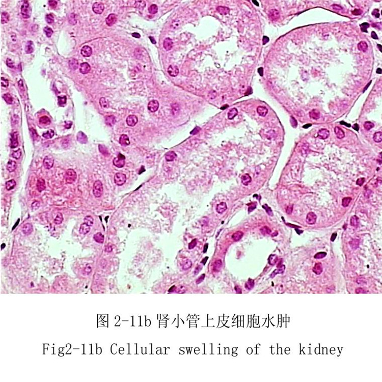 肾小管上皮细胞水肿