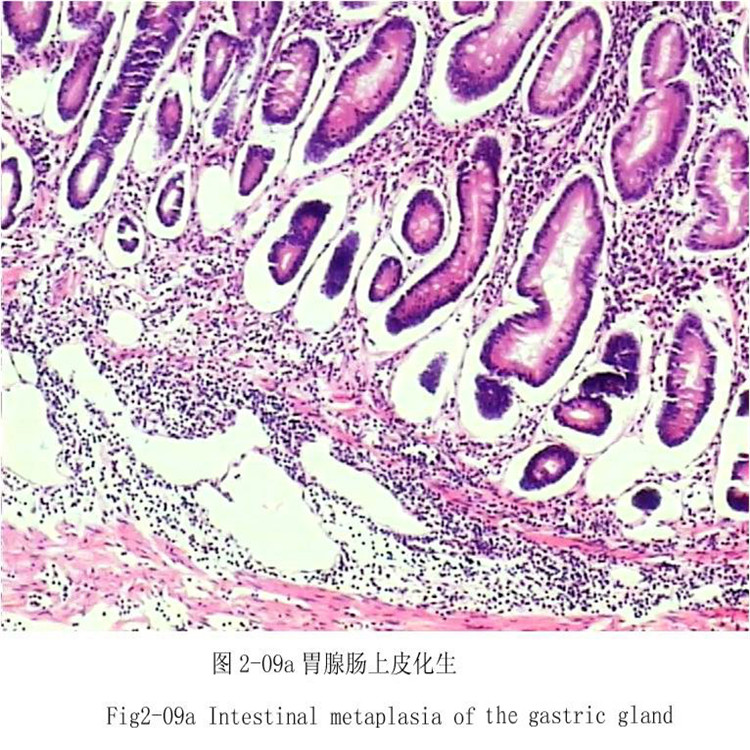 胃腺肠上皮化生