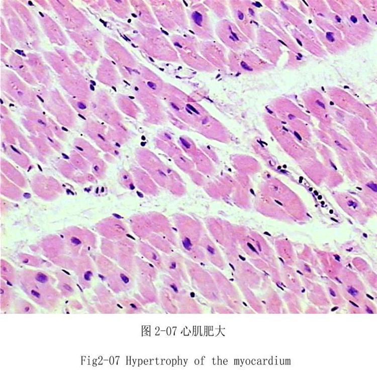 心肌肥大