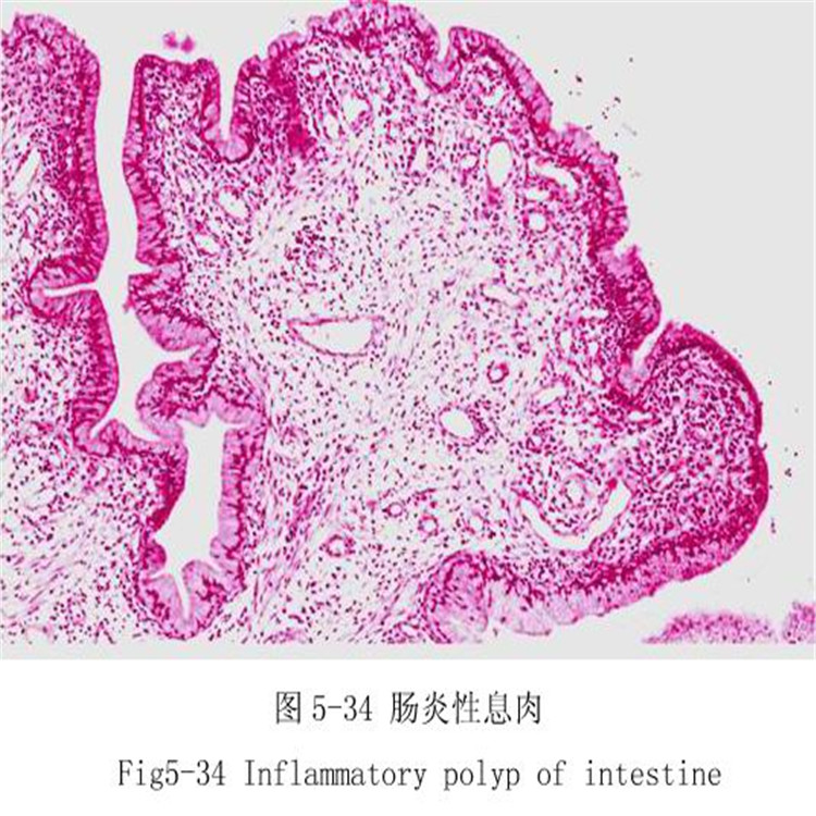肠炎性息肉