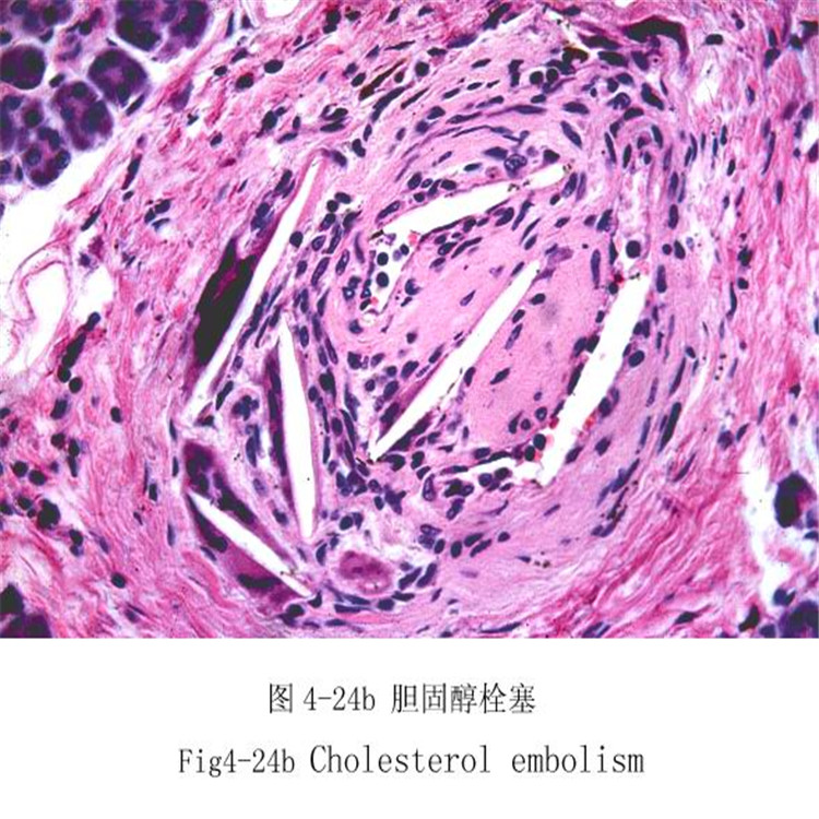 胆固醇栓塞