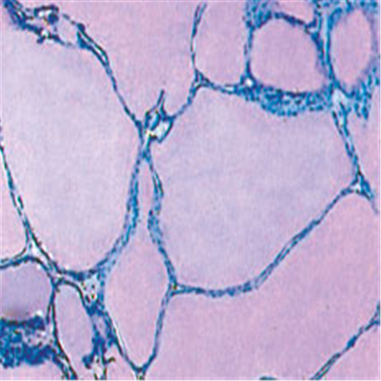 地方性甲状腺肿切片